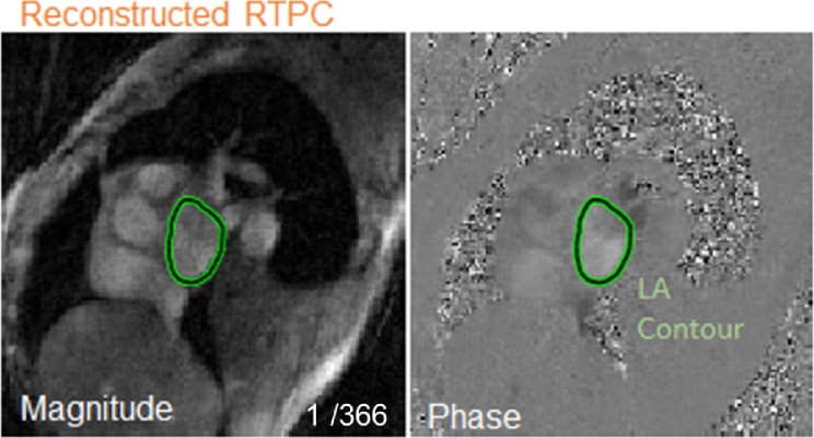 Atrial flow MRI figure relevant to automated left atrial segmentation and flow quantification