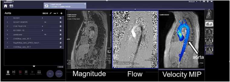 On-scanner 4D flow MRI display from the automated aortic hemodynamic analysis article