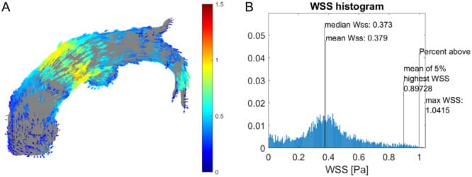 4D flow MRI pulmonary artery wall shear stress figure from the Pulmonary Circulation article