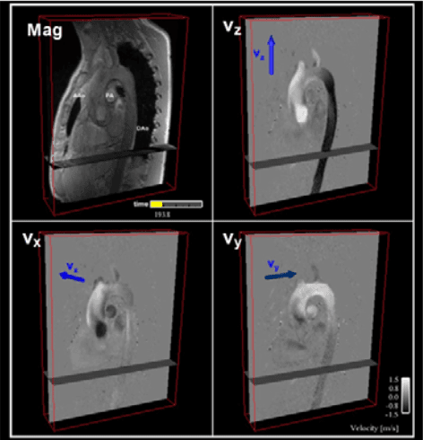 Automated 4D flow MRI pipeline figure relevant to Michael Markl's NIH-supported BAV hemodynamics project