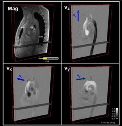 Magnitude and velocity-encoded 4D flow MRI acquisition data.