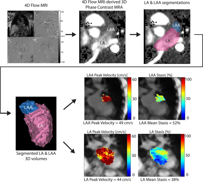 Figure showing automated left atrial and left atrial appendage segmentation with hemodynamic maps.